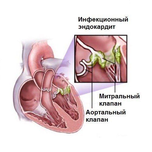 Синдромы инфекционного эндокардита