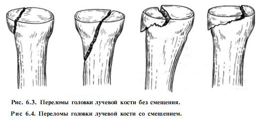 Переломом (fractura ossis) называется повреждение кости с нарушением ее целостности. Большинство переломов возникают под воздействием механической силы, превышающей прочность нормальной кости. Реже перелом происходит от незначительных усилий (от веса конечности, тела) и считается патологическим (в области опухоли, кисты, воспалительного процесса). Чаще переломы бывают закрытыми, реже (1:10) - открытыми (область перелома сообщается с раной). Если рана возникла от внешнего насилия, то перелом считается первично-открытым. Если кожа перфорирована отломком (осколком) кости изнутри, то перелом считается вторично-открытым. Это деление имеет принципиальное значение, так как при первично-открытом переломе разрушения мягких тканей и микробная агрессия могут существенно повлиять на хирургическую тактику и метод лечения перелома.