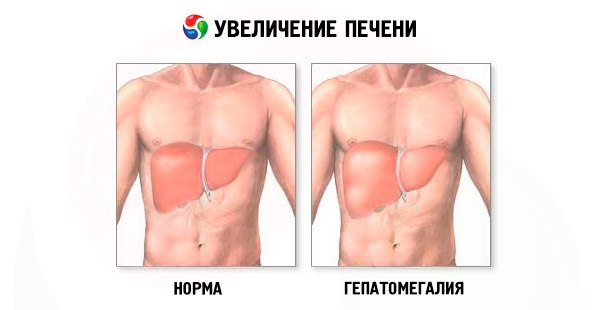 Клиническое значение увеличения печени 