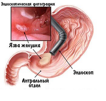 Язвенная болезнь желудка 