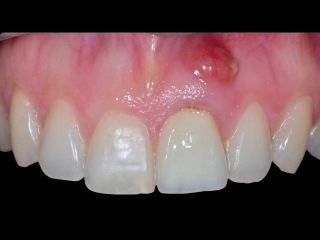 Dental Implant in the Aesthetic Zone