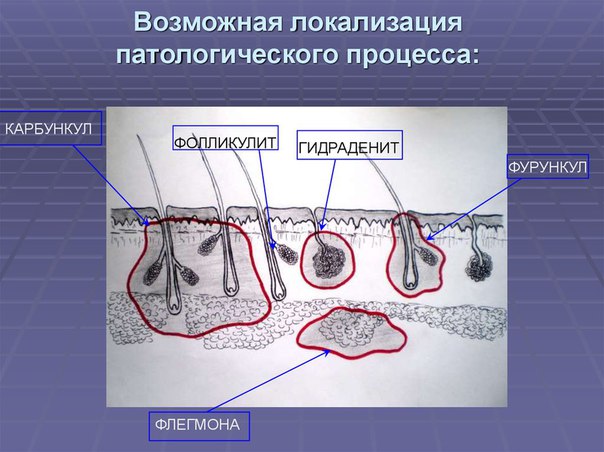Патологические процессы в подкожной основе 