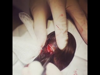 Scalp Cyst Removal