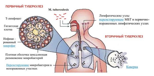 Лечение туберкулеза легких