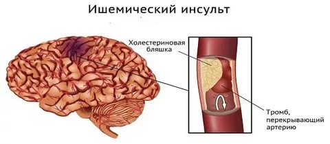Ишемический инсульт