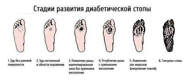 Диабетическая стопа 