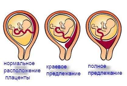 Предлежание плаценты - это неправильное ее прикрепление в матке, когда плацента располагается в области нижнего маточного сегмента, в той или иной степени перекрывая внутренний зев. В норме плацента прикрепляется в области тела матки, нижний край ее располагается выше внутреннего зева на 7 см и более. 