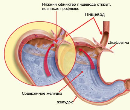 Изжога (pyrosis) – это неприятное ощущение жжения с локализацией преимущественно в загрудинной или подложечной области, то есть в зоне проекции нижней трети пищевода, распространяющееся снизу вверх, индивидуально возникающее в положении сидя, стоя, лежа или при наклонах туловища вперед, иногда сопровождающееся ощущением кислоты и/или горечи в глотке и во рту, нередко связанное с чувством переполнения в эпигастрии, возникающее натощак или после употребления какого-либо вида твердых или жидких пищевых продуктов, алкогольных или неалкогольных напитков или акта табакокурения; иногда ощущение жжения может иррадиировать в шею или лопатку. 