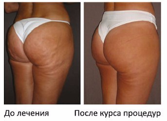 КАРБОКСИТЕРАПИЯ КАРБОКСИТЕРАПИЯ
