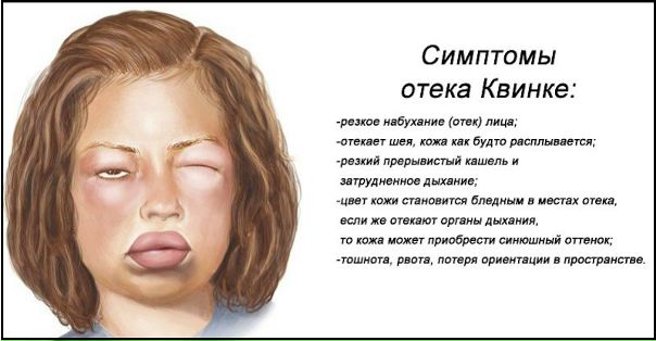 Отек Квинке 
