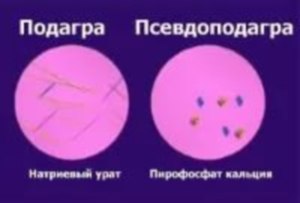 Хондрокальциноз, симптомы, признаки, лечение