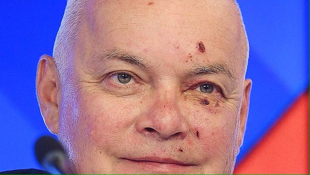"Проехался лицом по гравию", - пропагандист Киселев рассказал, почему приехал из Коктебеля с разбитым лицом - Цензор.НЕТ 1419
