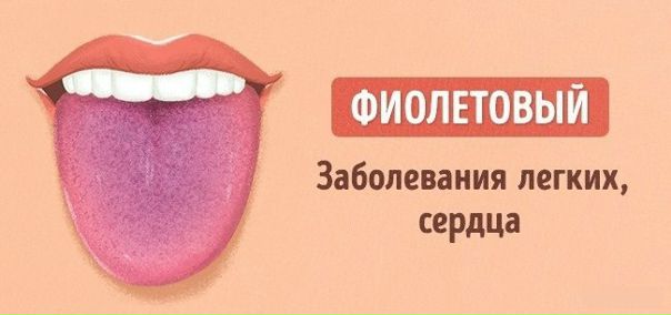 9 проблем, о которых может рассказать цвет языка 