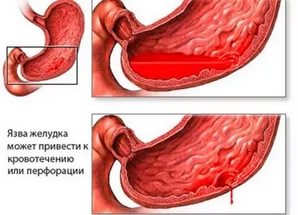Помощь желудку