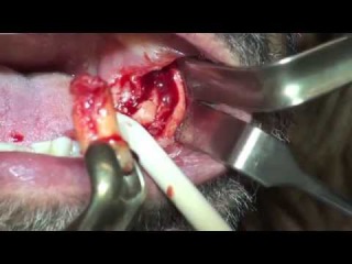 Removal dental mandible cysts ,dr.Stefano Piras (Rimini)