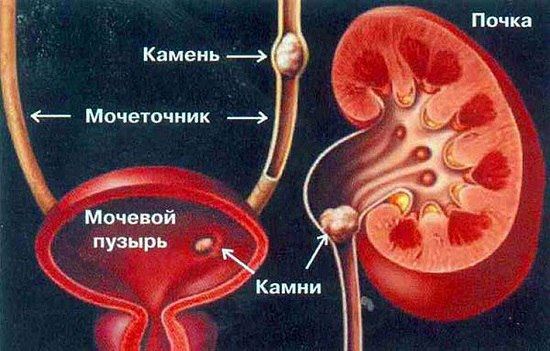 Почечная колика - это приступ резких болей, возникающий при острой (внезапной) обструкции верхних мочевыводящих путей (лоханки или мочеточника) в результате их внутренней окклюзии или внешнего сдавления. 