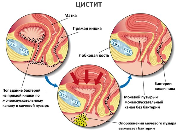 Лечение острого цистита