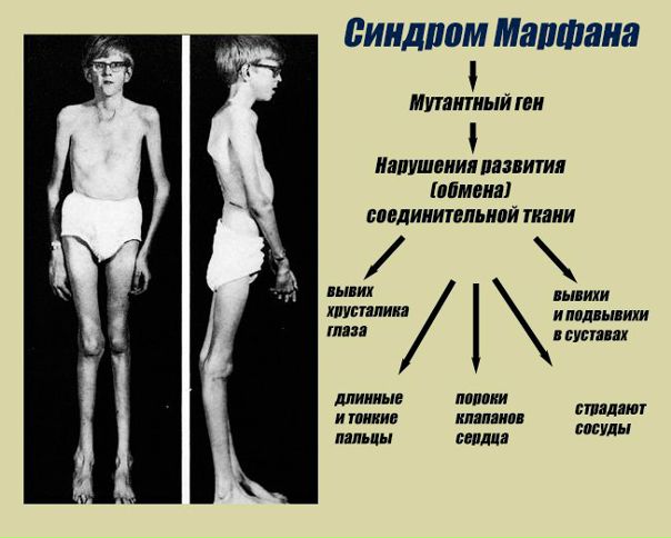Синдром Марфана (Марфана-Ашара) – это наследственное заболевание соединительной ткани с аутосомно-доминантным типом наследования и с преимущественным поражением сердечно-сосудистой системы, скелета и органа зрения. 