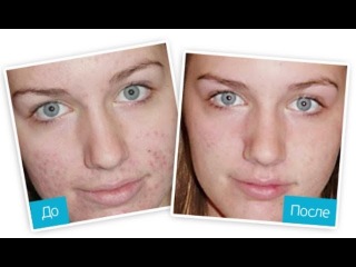 Пигментные Пятна исчезнут за 1 курс применения с маской Miracle Glow!