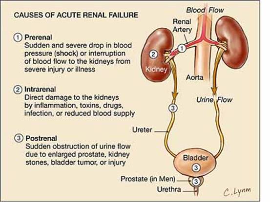 Острое повреждение почек (acute kidney injury) – внезапная утрата функции почек. Термин пришел на смену ранее употребляемого «острая почечная недостаточность». 