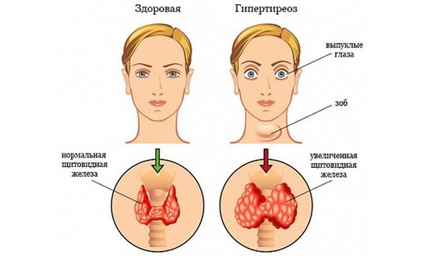 Лечение щитовидной железы