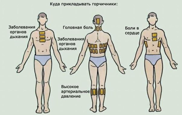 СТАВИМ ГОРЧИЧНИКИ ПРАВИЛЬНО! 