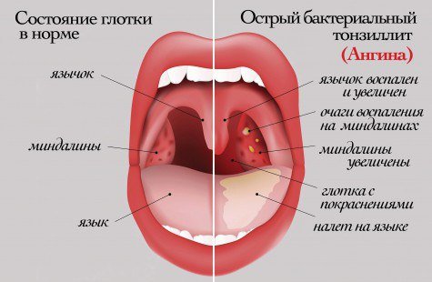 СОВЕТЫ ДЛЯ ТЕХ,КТО ЧАСТО БОЛЕЕТ АНГИНОЙ :)