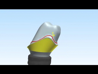Custom Abutment DesignDesign of a Straumann titanium custom implant abutment for a KDZ Bruxer® crown.