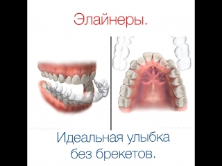 Элайнеры. Идеальная улыбка без брекетов.
