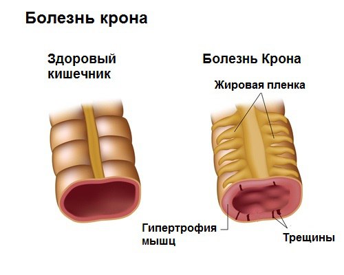 Болезнь Крона – это хроническое (длительностью более 6-ти месяцев) заболевание желудочно-кишечного тракта, которое может поразить любой отдел пищеварительной системы, чаще всего конечный отдел тонкой и/или толстую кишку. 