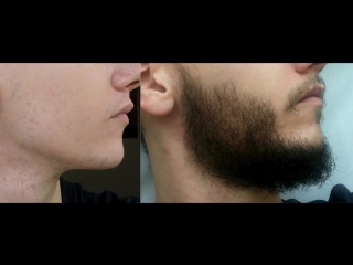 MINOXIDIL (МИНОКСИДИЛ) - Средство №1 для отращивания бороды
