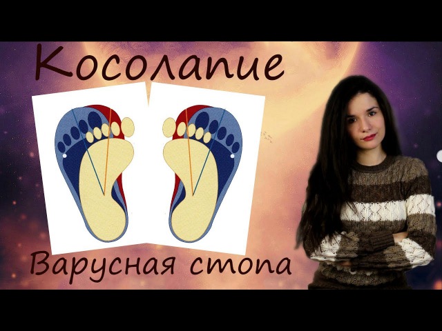 Косолапие Варусная стопа