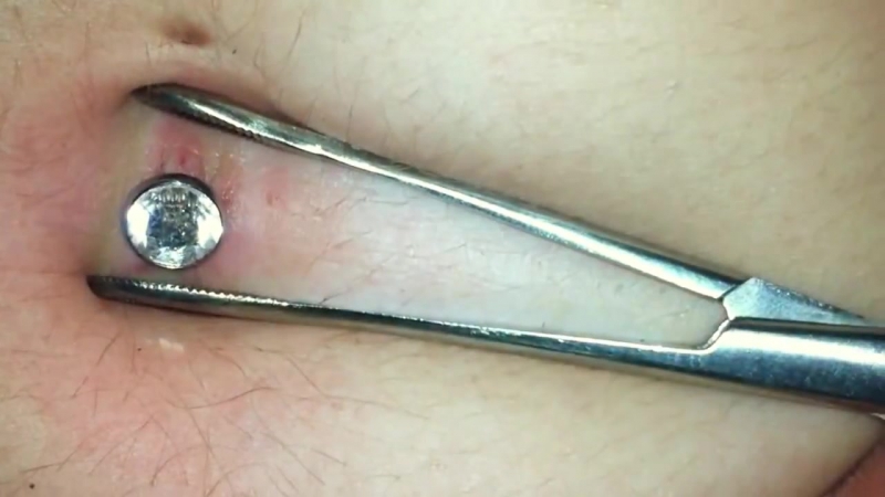 Surgery 2 Phase two - YouTube