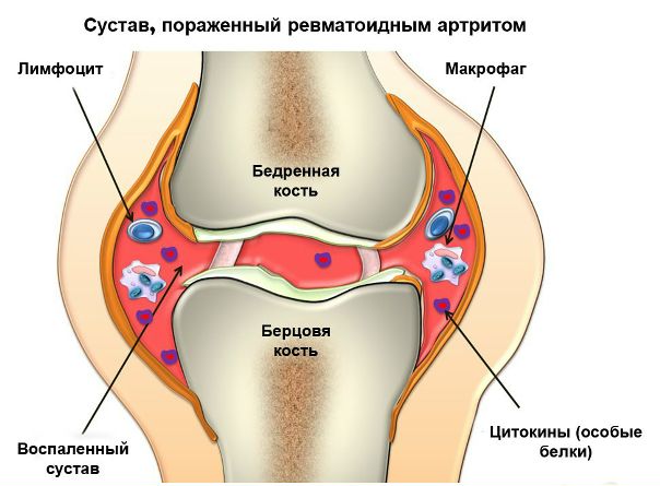 Ревматоидный артрит Ревматоидный артрит