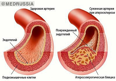 Атеросклероз сосудов сердца