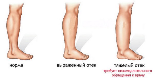 Отеки 