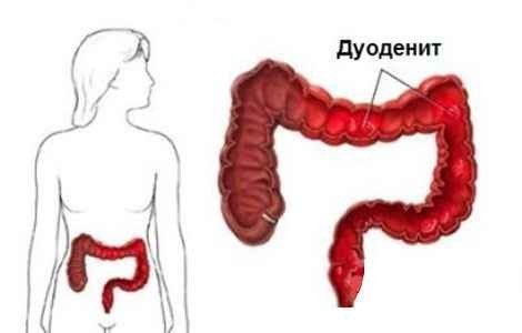 Хронический дуоденит - заболевание, характеризующееся воспалительно-дистрофическим поражением слизистой оболочки двенадцатиперстной кишки. 