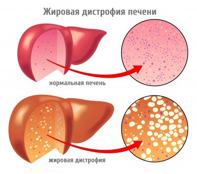 Жировая дистрофия 