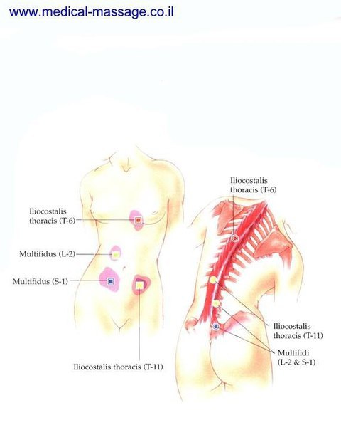 Триггерные точки на теле человека карта