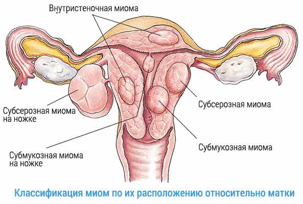 Некоторые считают, что тиозинамин может помочь в лечении миомы матки.