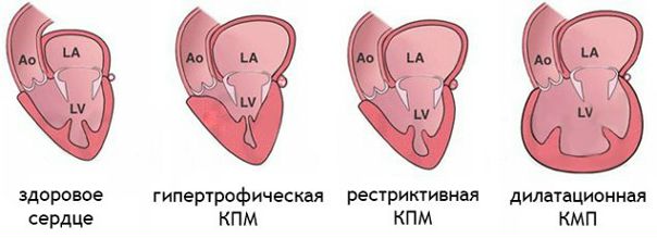Классификация кардиомиопатий Классификация кардиомиопатий
