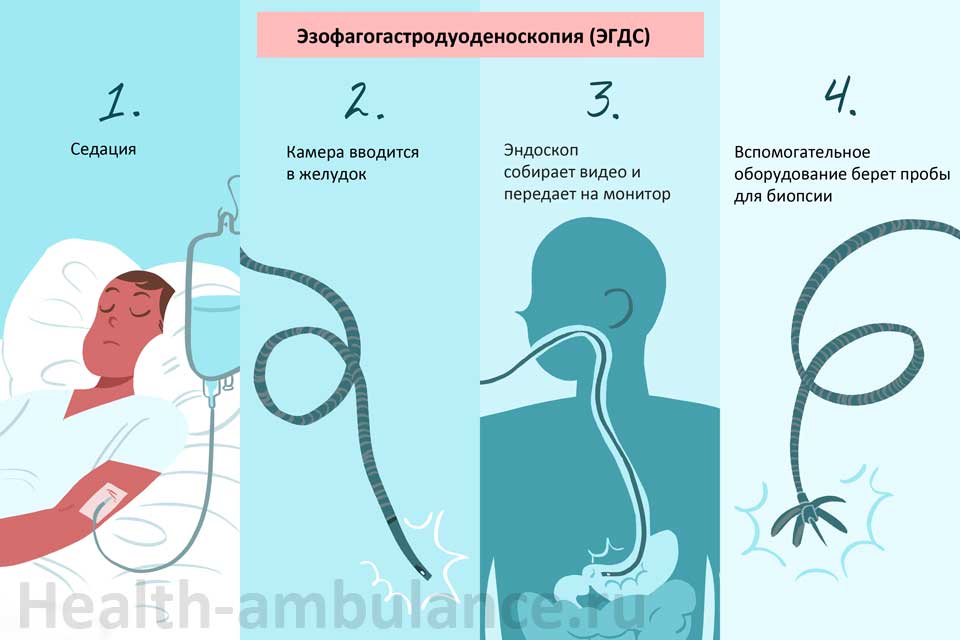 Верхняя эндоскопия Эзофагогастродуоденоскопия (ЭГДС)