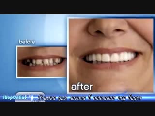 Съемные виниры Snap On Smile