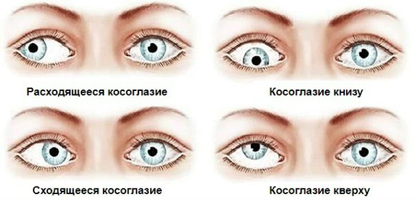 Косоглазие (strabismus) - отклонение (девиация) одного глаза от общей точки фиксации. 