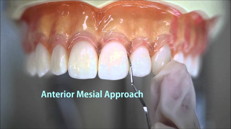 How to use Dental Explorer 11-12