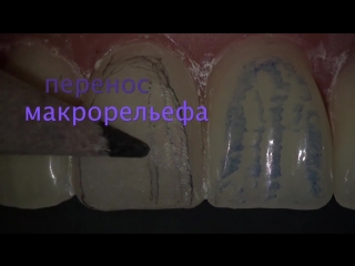 Обработка реставрации. Dr. Denis Krutikov