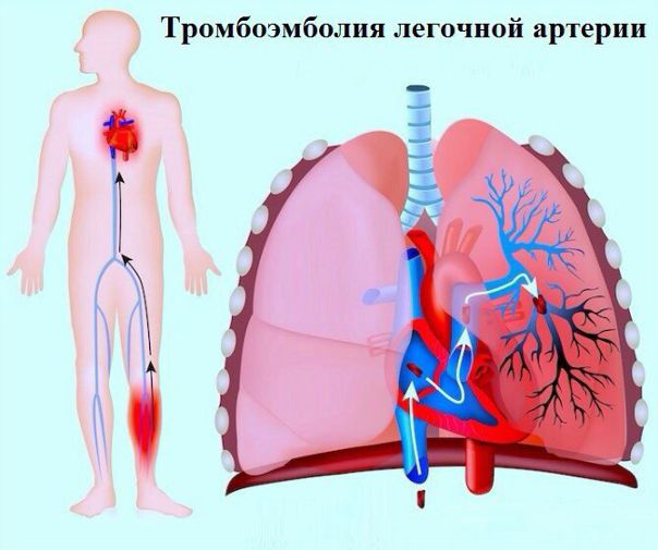 Тромбоэмболия лёгочной артерии 