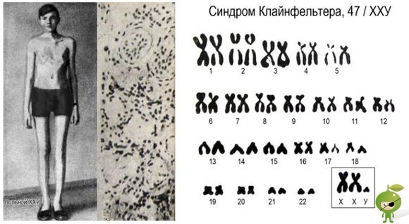синдром клайнфельтра был открыт в 1942 году ребятками, которых звали гарии клайнфельтр и фуллер олбрайт. в отличии от других синдромов, которые были у нас до этого, он имеет имеет несколько