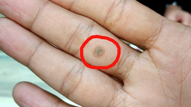 How to Remove Warts Easily at Home