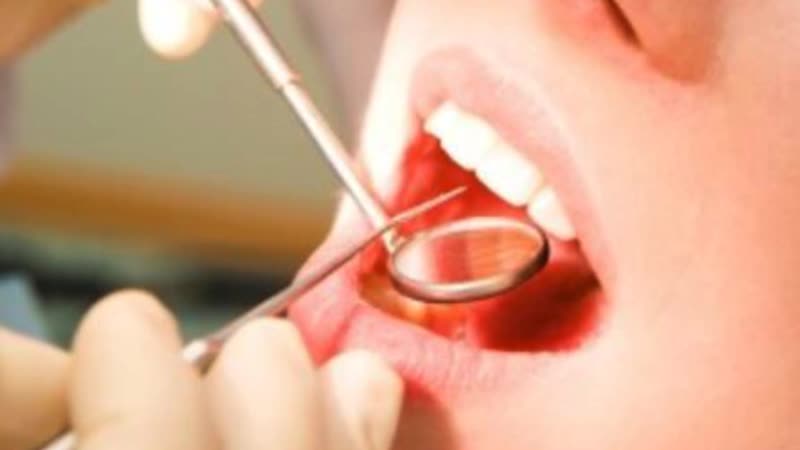 Dental Bridges Miami | Dental Caps